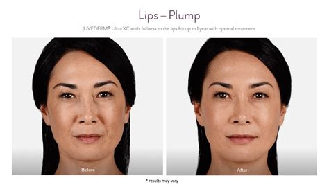 Dermal Fillers Fort Worth Restore Youthful Contours
