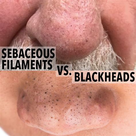 Blackheads Vs Sebaceous Filaments Whats The Difference Sebaceous