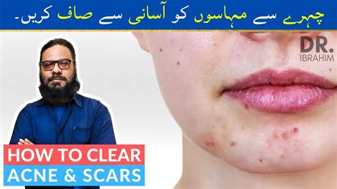 Muhaseacne Ka Ilaj How To Clear Your Face From Acnezitspimple