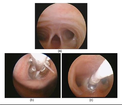Figure From Bronchoscopy And Fogarty Balloon Insertion Of Distal
