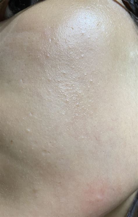 Skin Concerns What Is This And How Do I Get Rid Of It U Cant Rlly