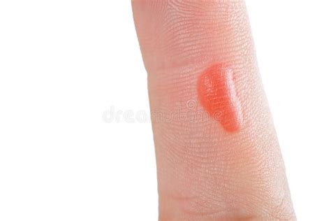 There Is A Blister On Womanand X27s Hand From A Burn Burn Of The Finger