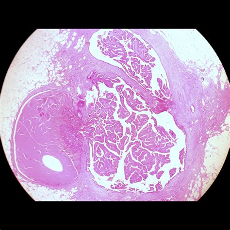 Intraductal Papilloma Of The Breast Image