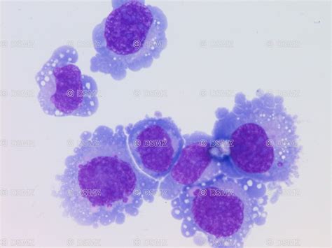 Mesothelioma Vs Reactive Mesothelial Cells Cytology 2022e Jurnal