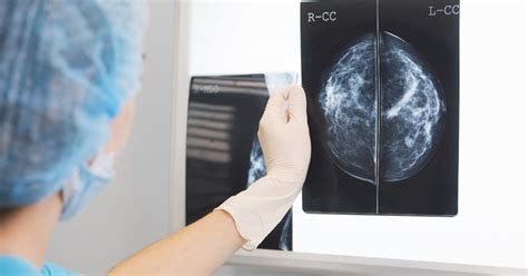 Mamografia Para Câncer De Mama O Que é E Quando Fazer Esse Exame