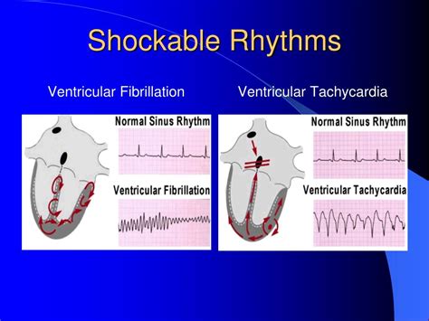 Shockable Vs Non Shockable Rhythm