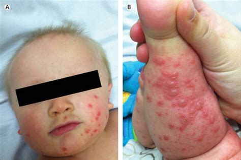 Atypical Hand Foot And Mouth Disease A Vesiculobullous Eruption Caused By Coxsackie Virus A6