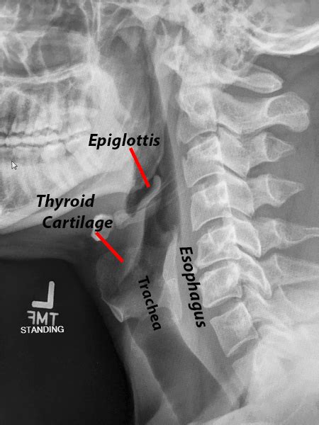 It looks like a mole, bug bite, or pimple. To Open The Airway, Optimally Position The Head and Neck ...