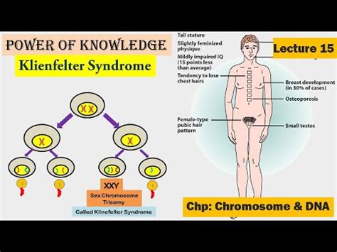Klinefelter Syndrome Chromosomal Disorder Lecture 15 YouTube