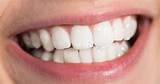 Pictures of How Many Teeth Whitening Treatments Do I Need