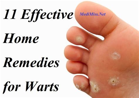 11 Effective Home Remedies For Warts Skinnyzine