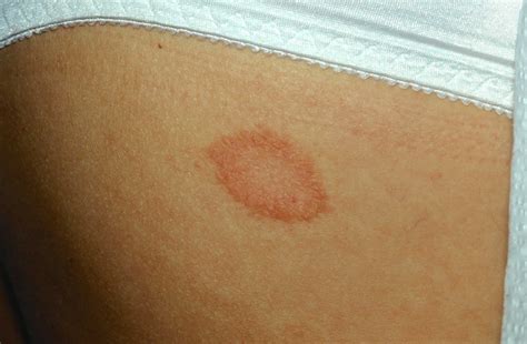 Pityriasis Rosea In Children Causes Symptoms Diagnosis And Treatment