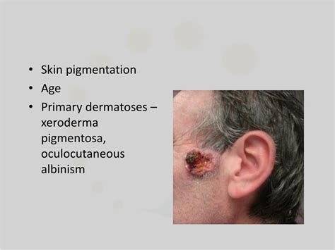 Ppt Squamous Cell Carcinoma Powerpoint Presentation Free Download