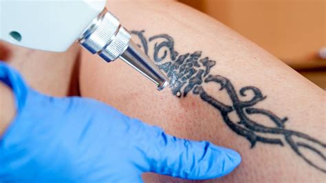 How Does Tattoo Removal Work Mental Floss