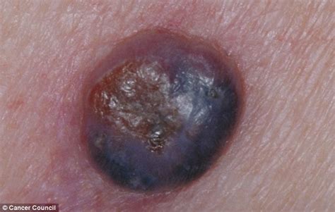 The Killer Pimple Doctors Warn Of Aggressive Form Of Skin Cancer Which