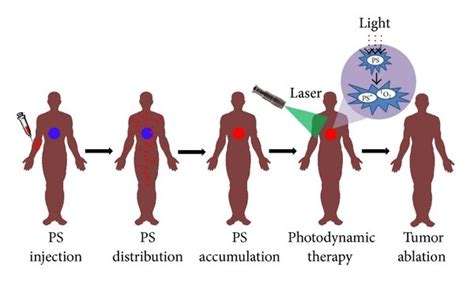 Clinical Photodynamic Therapy ¹o2 Singlet Oxygen Ps Download