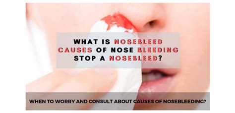What Is Nosebleed Causes Of Nose Bleeding Stop A Nosebleed In 2020
