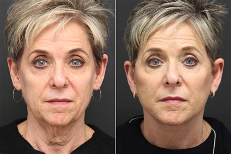 Facelift Before And After Photos Nicole Schrader Md Facs