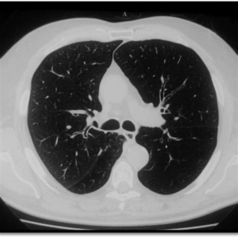 Ct Of A Patient With Emphysema With Giant Bulla Note Chest Hrct Of
