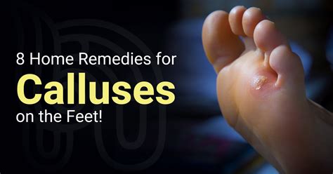 Foot Callus Remover Remedies Foot Care Tips