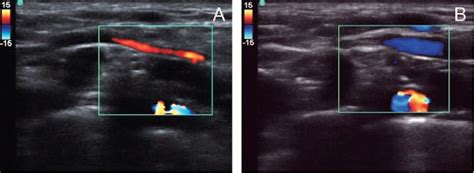 Figure 4 From The Presence Of Transverse Cervical And Dorsal Scapular