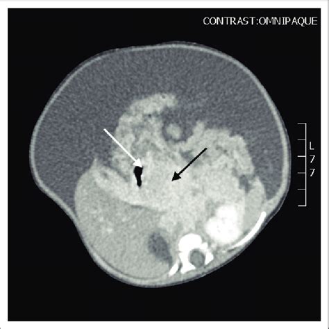 Axial Post Contrast Computed Tomography Image Demonstrating The Locally