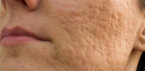 Acne And Acne Scarring Treatments Mesa Az Sagebrush Dermatology