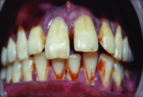 Pre Operative Photograph Showing Palatally Tipped Left Central Incisor
