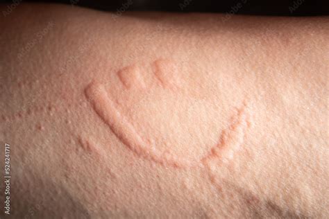 Smiling Face Hives Hives Spread When You Scratch On The Skin Stock