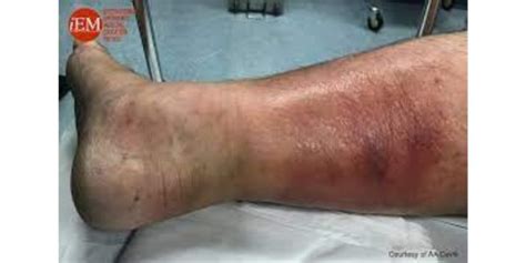 Cellulitis Causes Symptoms Treatment And Prevention