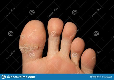 Close Up Of Cracked Foot Fingers Of Human Skin Isolated On Back