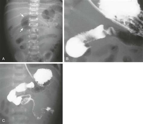 Diseases Of The Pediatric Stomach And Duodenum Radiology Key