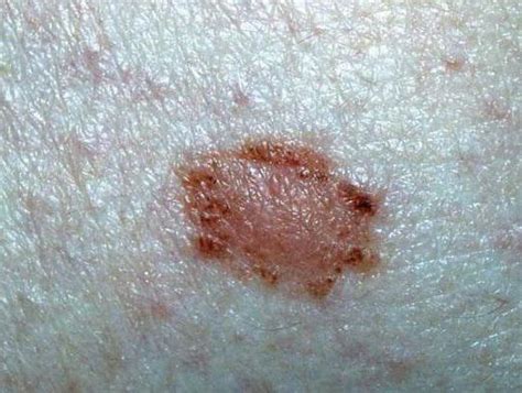 Nevus Melanocitario Nevo Papillomatoso Foto Il Nevo Melanocitario