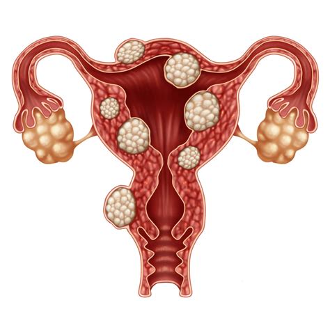 Oct 07, 2011 · further, because the cyst is filling with fluid, the cyst can grow fairly rapidly. Is It an Ovarian Cyst or a Fibroid? - Cherokee Women's Health