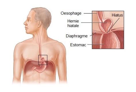 La hernie hiatale est elle curable Améliore ta Santé