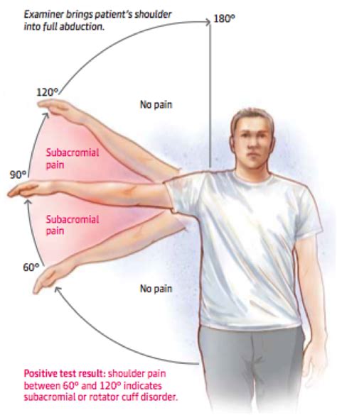 Shoulder impingement syndrome develops when the shoulder tendons get intermittently trapped and squashed underneath one of the shoulder bones, the acromion. SUBACROMIAL SHOULDER IMPINGEMENT SYNDROME
