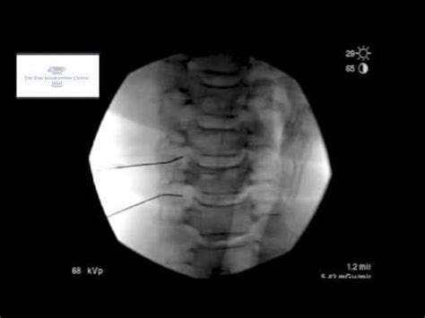 Cervical Transforaminal Epidural Sterioid Injection Youtube