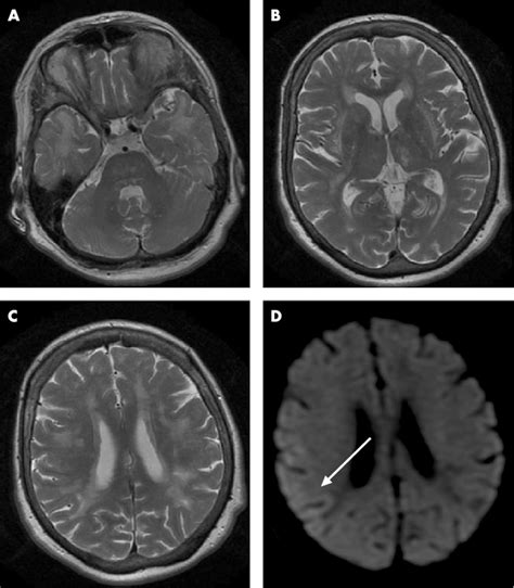T2 Weighted Mri Scans Showing Diffuse Hyperintense Signal Abnormalities