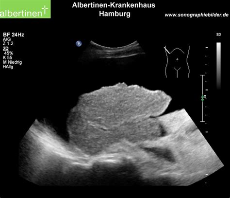 Cirrhosis Small Liver Ascites Ultrasound Doccheck