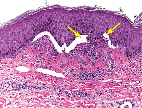 New Bullous Lesions In A 72 Year Old Woman Cleveland Clinic Journal