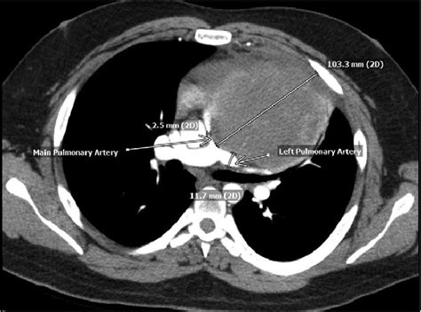 Ct Chest With Iv Contrast On Presentation Showing Mediastinal Mass Of