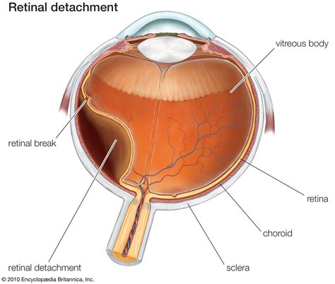 detached retina | eye disorder | Britannica