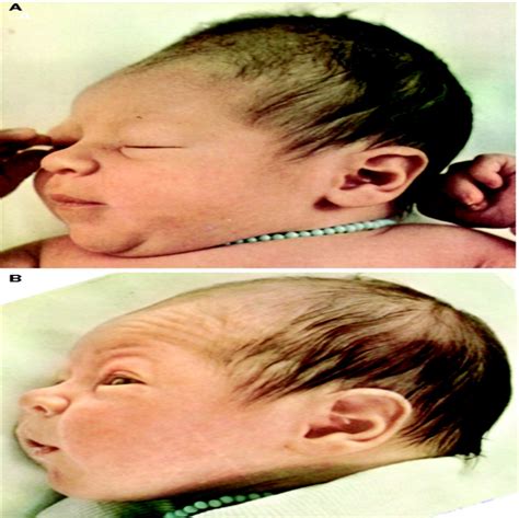 An Overview Of Positional Plagiocephaly And Cranial Remoldin Jpo