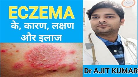 Eczema का इलाज। Eczema Treatment In Ayurveda Eczema Treatment In Hindi