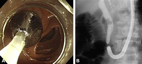 Outcomes Of Ercp In Billroth Ii Gastrectomy Patients Gastrointestinal