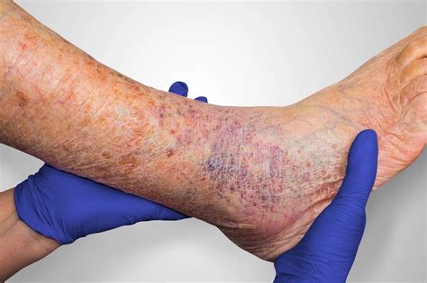 8 Warning Signs Of Vein Disease 2 Discoloration Of The Skin