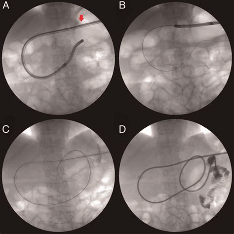 Radiological Imaging Of Percutaneous Endoscopic Transgastric