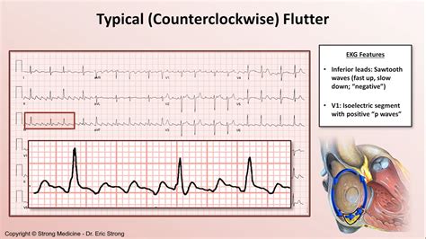 Typical Counterclockwise Atrial Flutter On EKG GrepMed