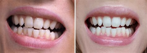 Professional Teeth Whitening At Home