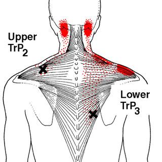 You maintain the position of the core while moving the other parts of the body. Referred pain patterns (red) from the upper and middle trapezius muscle... | Download Scientific ...